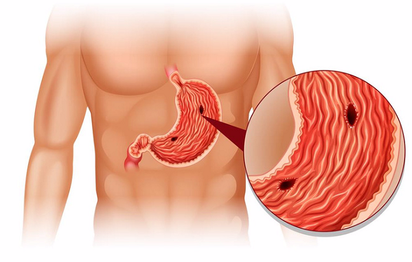 Nhiều bạn trẻ bị thủng dạ dày vì thức khuya, ăn không đúng giờ giấc
