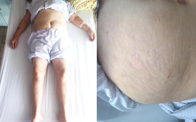 Bệnh nhân bị Hội chứng Cushing do lạm dụng corticoid.