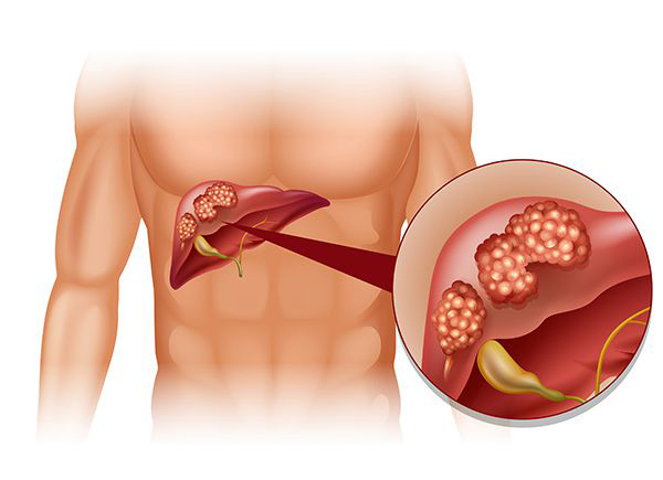 Viêm gan B, C âm thầm ung thư hóa khiến nhiều người tử vong
