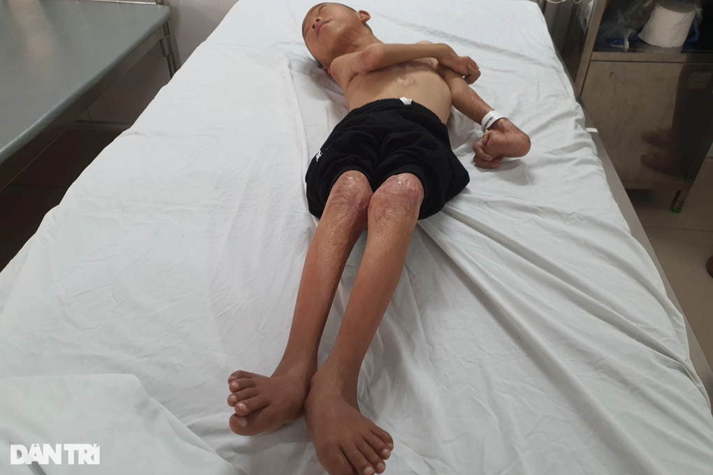 Cháu Trường với cơ thể biến dạng vì bỏng (ảnh Dân trí)