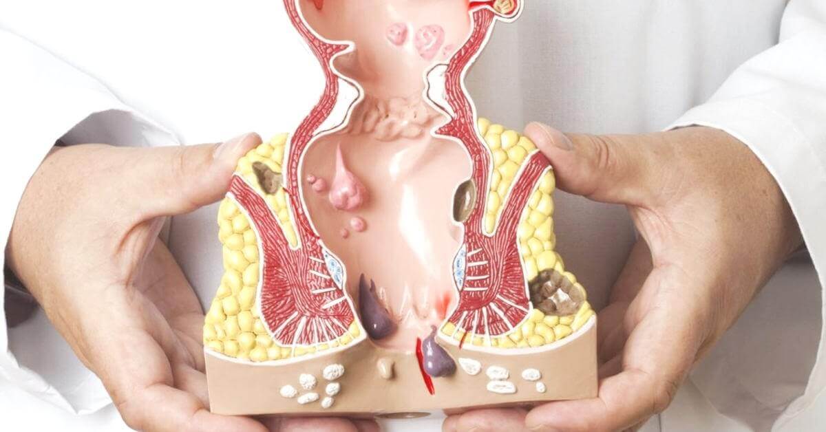 trĩ nội là gì