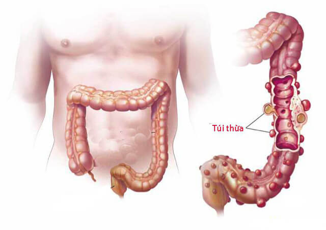 Tìm hiểu về bệnh túi thừa đại tràng