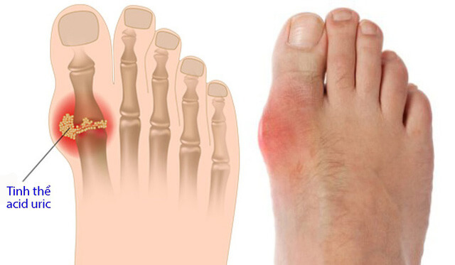 5 yếu tố làm tăng nguy cơ mắc bệnh Gút