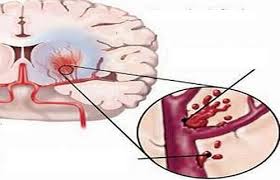 Hỏi: Thành mạch rất yếu, đã bị xuất huyết não 1 lần?