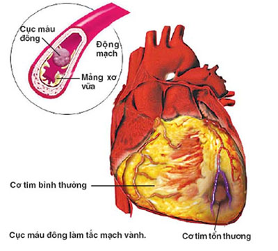 Xơ vữa động mạch- kẻ giết người thầm lặng